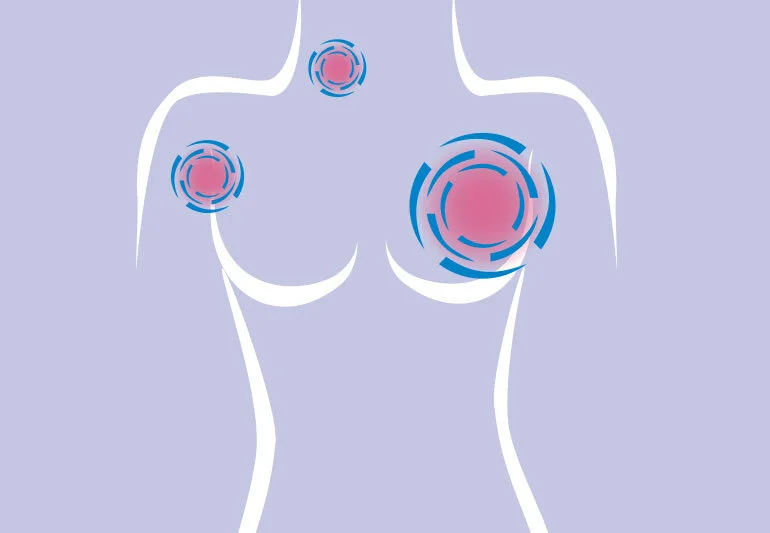 Estratégias para prevenção do câncer de mama