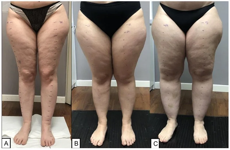 Lipedema: importância da ciência de precisão