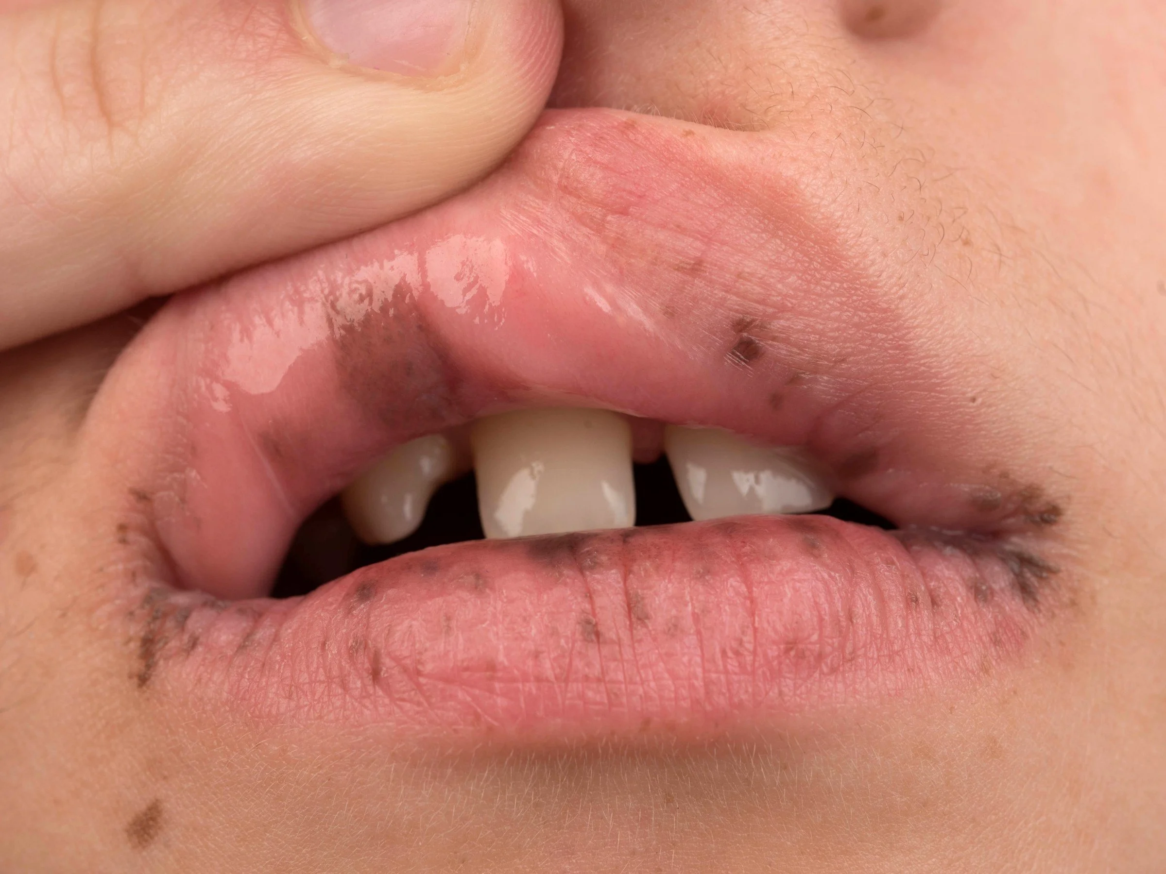 Alteração de microbiota intestinal na síndrome de Peutz-Jeghers (PJS)