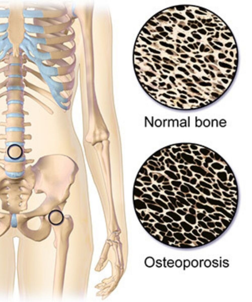 Bone Density (DEXA) Scan