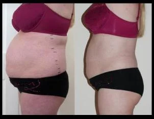 Medical Study: Laser Lipo - Non-invasive, Instant Fat Reduction, 6 inches Average Loss.