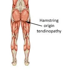 Hamstring:  Proximal Strain & Tendinopathy