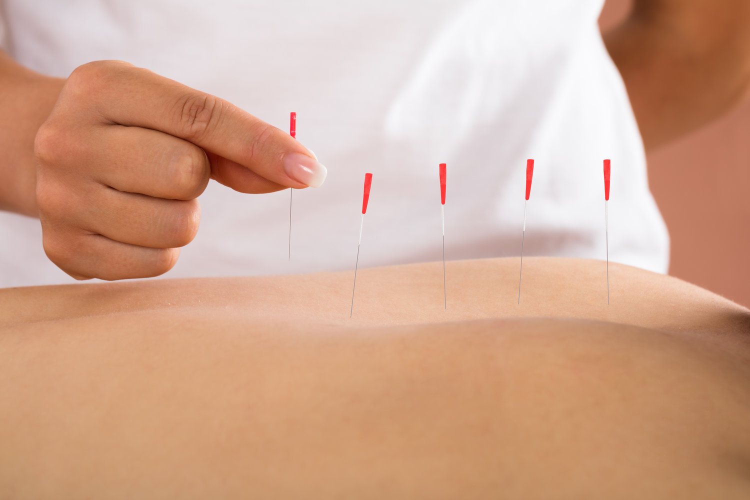 Dry Needle Therapy: How Does It Work?