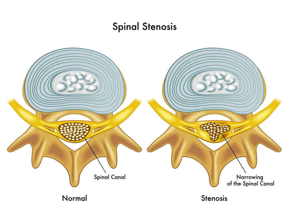 Sciatica Pain Relief - Anatomy & Definition — Revive Sport & Spine