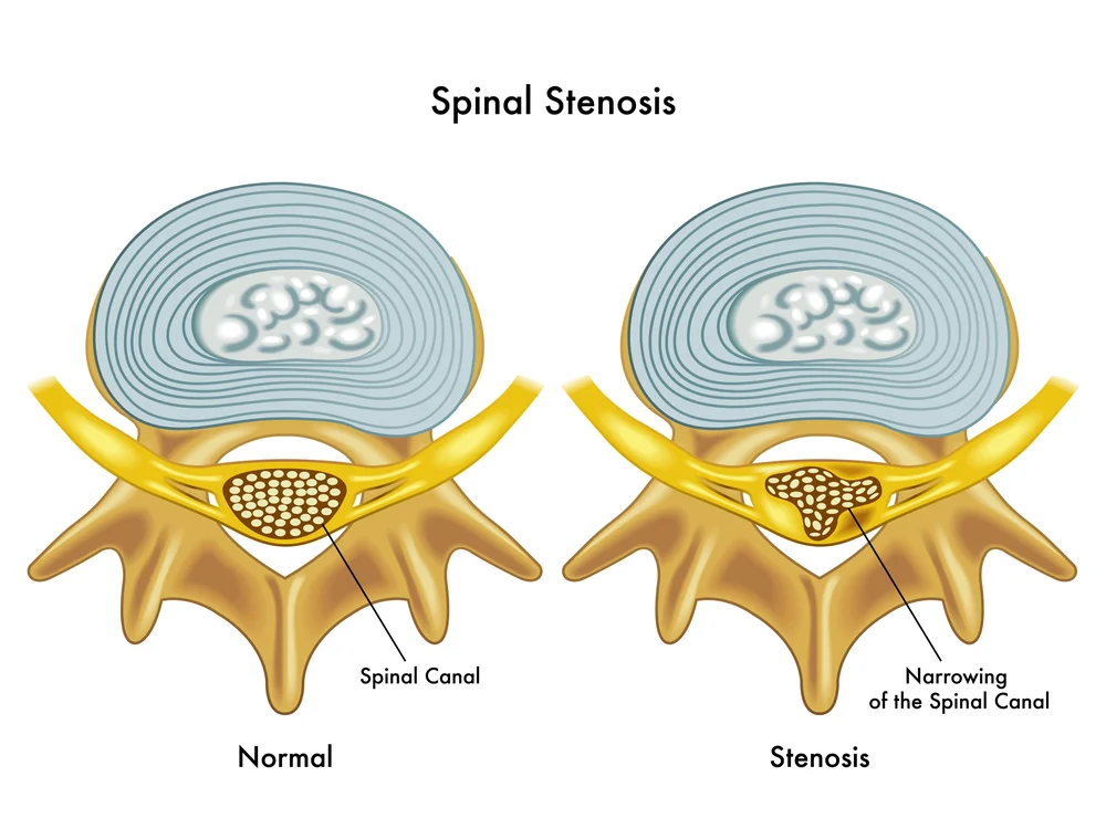Sciatica_SciaticNervePain_LowBackPain_SLC_Utah_Chripractor.jpg