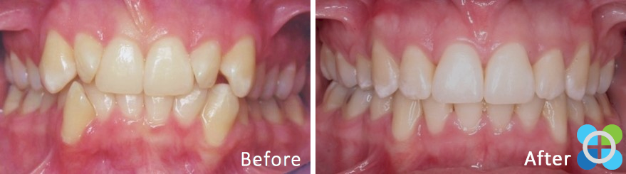 4-orthodontique-before-after-braces.png