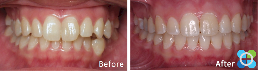 5-orthodontique-before-after-braces.png