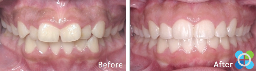 6-orthodontique-before-after-braces.png