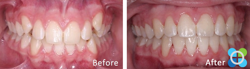 7-orthodontique-before-after-braces.png