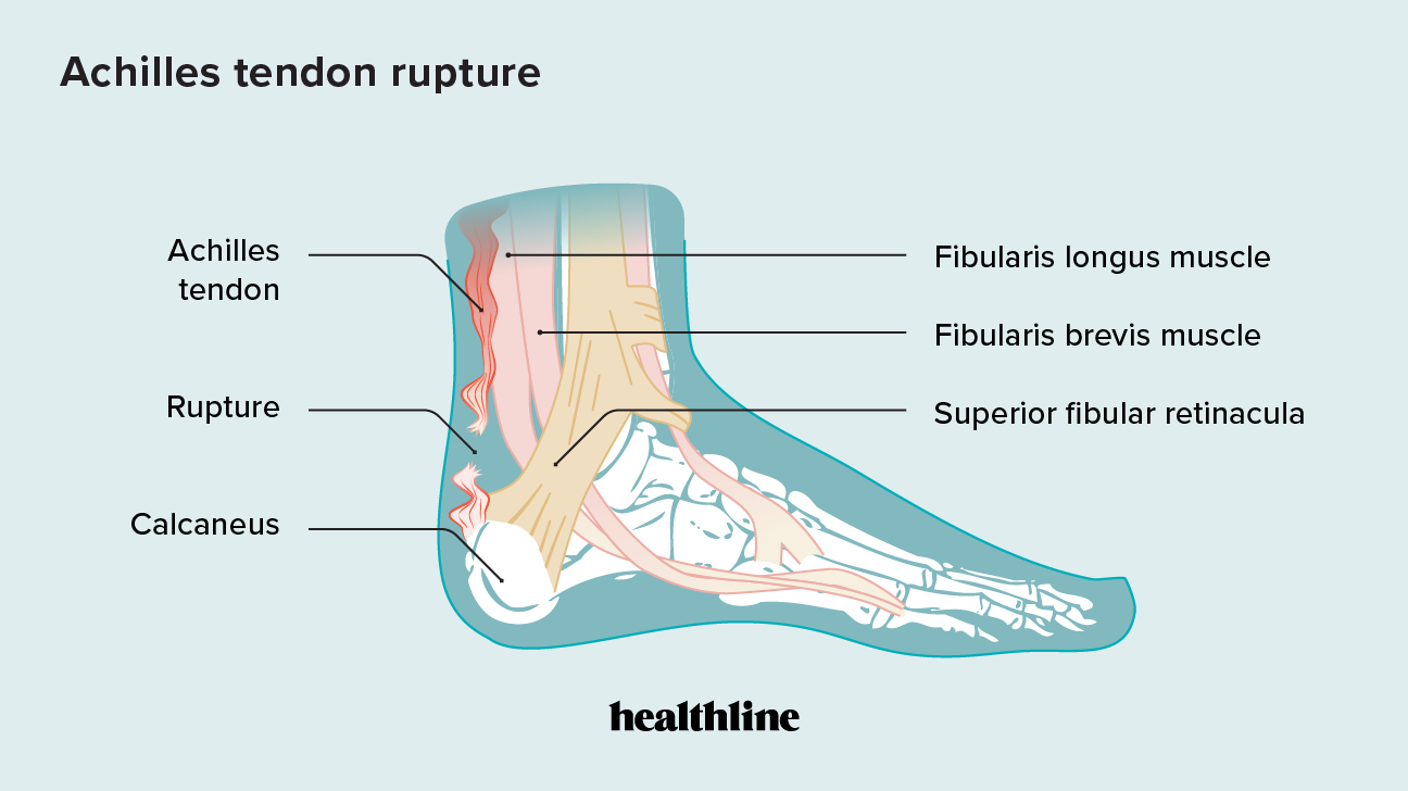 2456967 - ruptured achilles tendon_1296x728-body.png