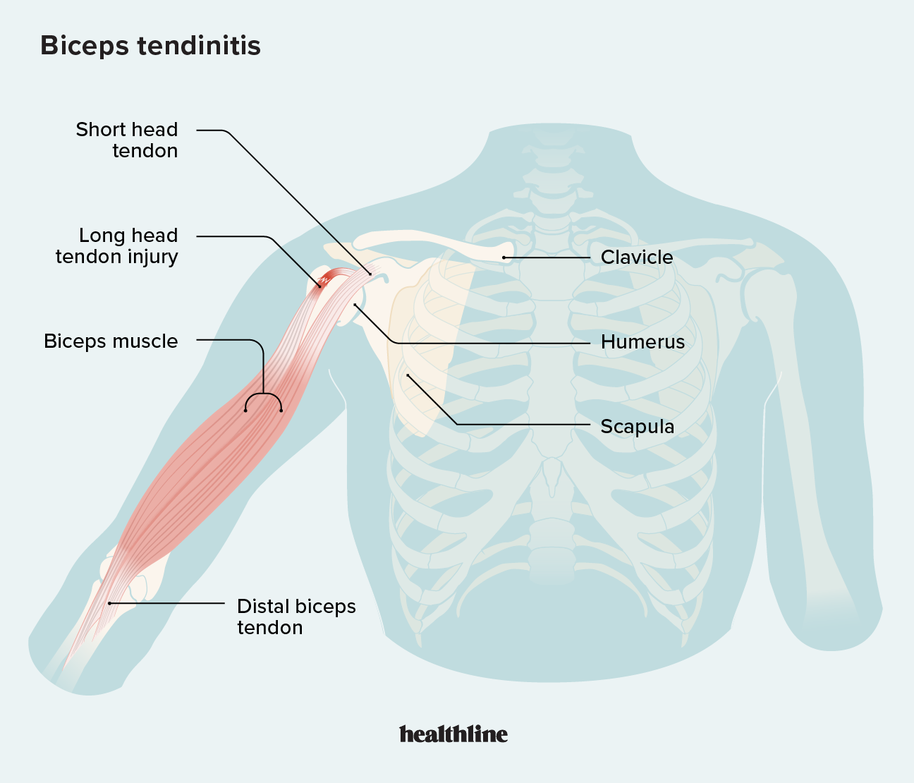 2489475 - bicep tendonitis_1296x1010-body.png