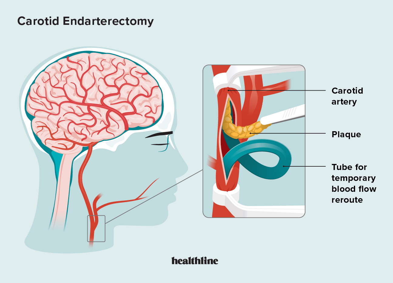 2631160 - FAQ Carotid Endarterectomy_1296x933_body.png
