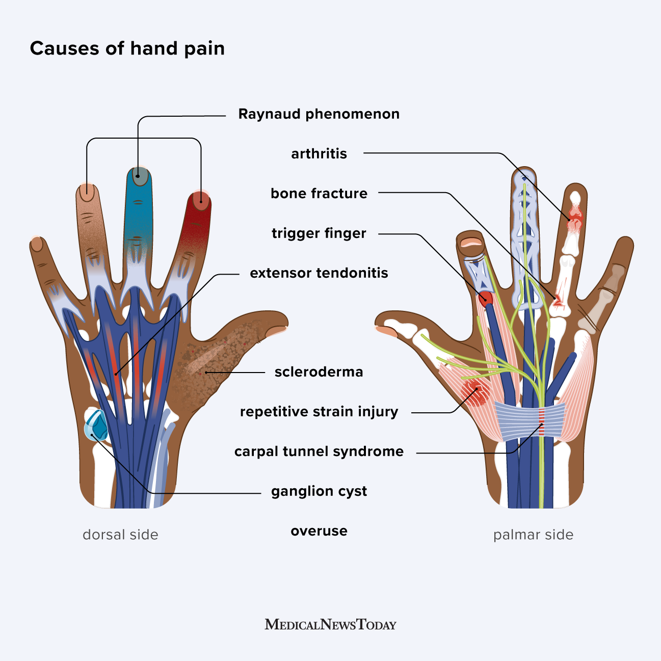 3665043 - Why Does My Hand Hurt_1296x1296-body.png