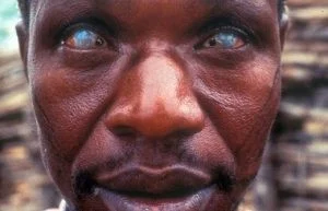 River Blindness.jpg