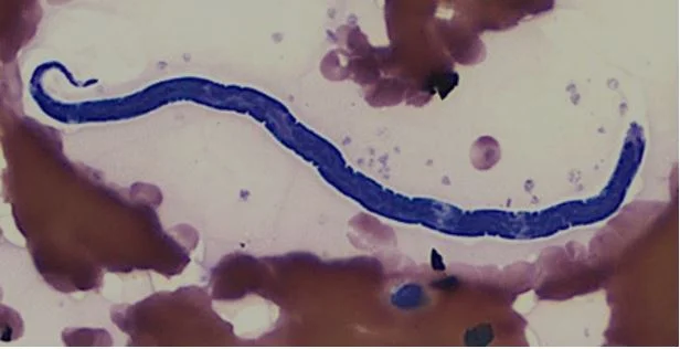 Loiasis — Drugs & Diagnostics for Tropical Diseases