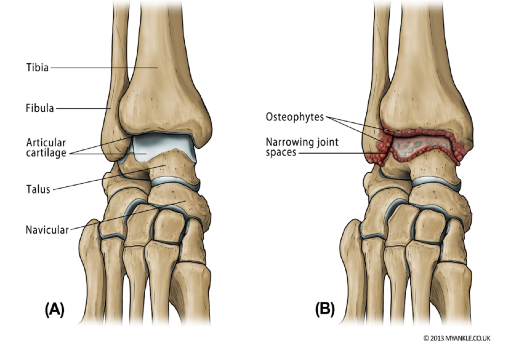 Ankle Arthritis — Ankle Arthritis, Ankle Replacement, Arthrodesis