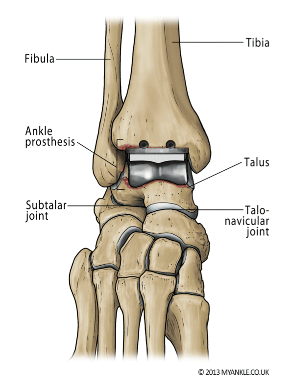 Ankle Replacement — Ankle Arthritis