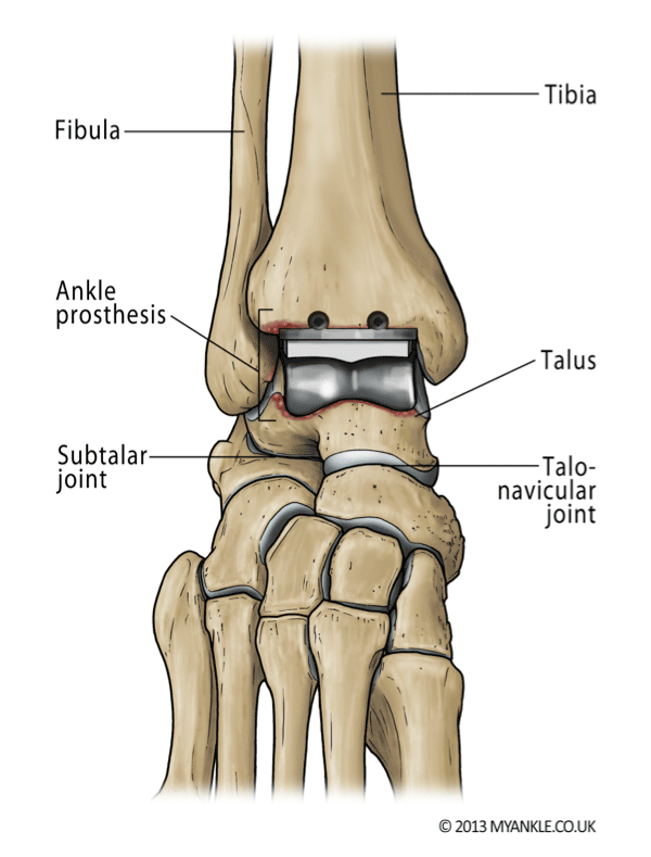 Ankle Replacement — Ankle Arthritis, Ankle Replacement, Arthrodesis