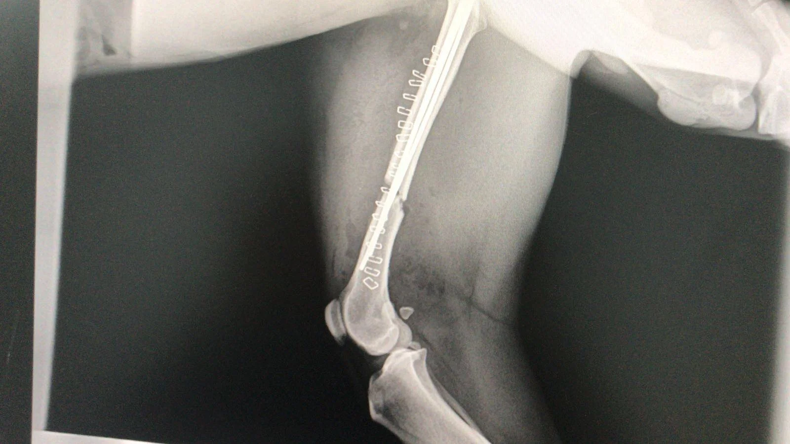 Post surgery, break now pinned