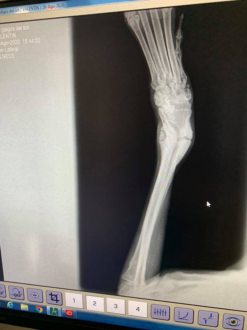 X-ray showing break.
