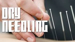 Dry Needling Safety, Guidelines &amp; Requirements