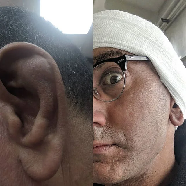 It was only a little #haematoma they said. FFS! 
Ah well, back to work....😫 #hajewellery