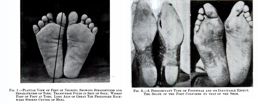 CONCLUSIONS DRAWN FROM A COMPARATIVE STUDY OF THE FEET OF BAREFOOTED AND SHOE-WEARING PEOPLES / PHIL. HOFFMANN J Bone Joint Surg Am. 1905;s2-3:105-136.