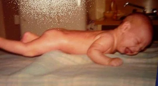 james as a newborn being placed face down on his painful circumcision wound