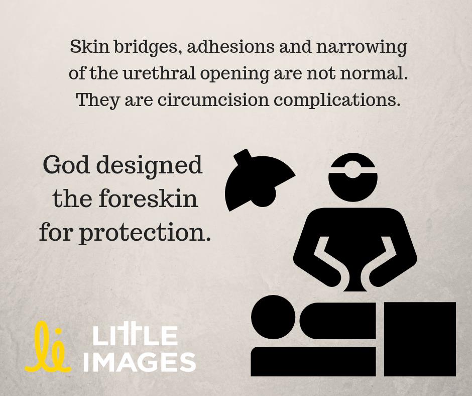  Image: Stick figure doctor standing over patient in a bed. Text: “Skin bridges, adhesions and narrowing of the urethral opening are not normal. They are circumcision complications. God designed the foreskin for protection.” Little Images 