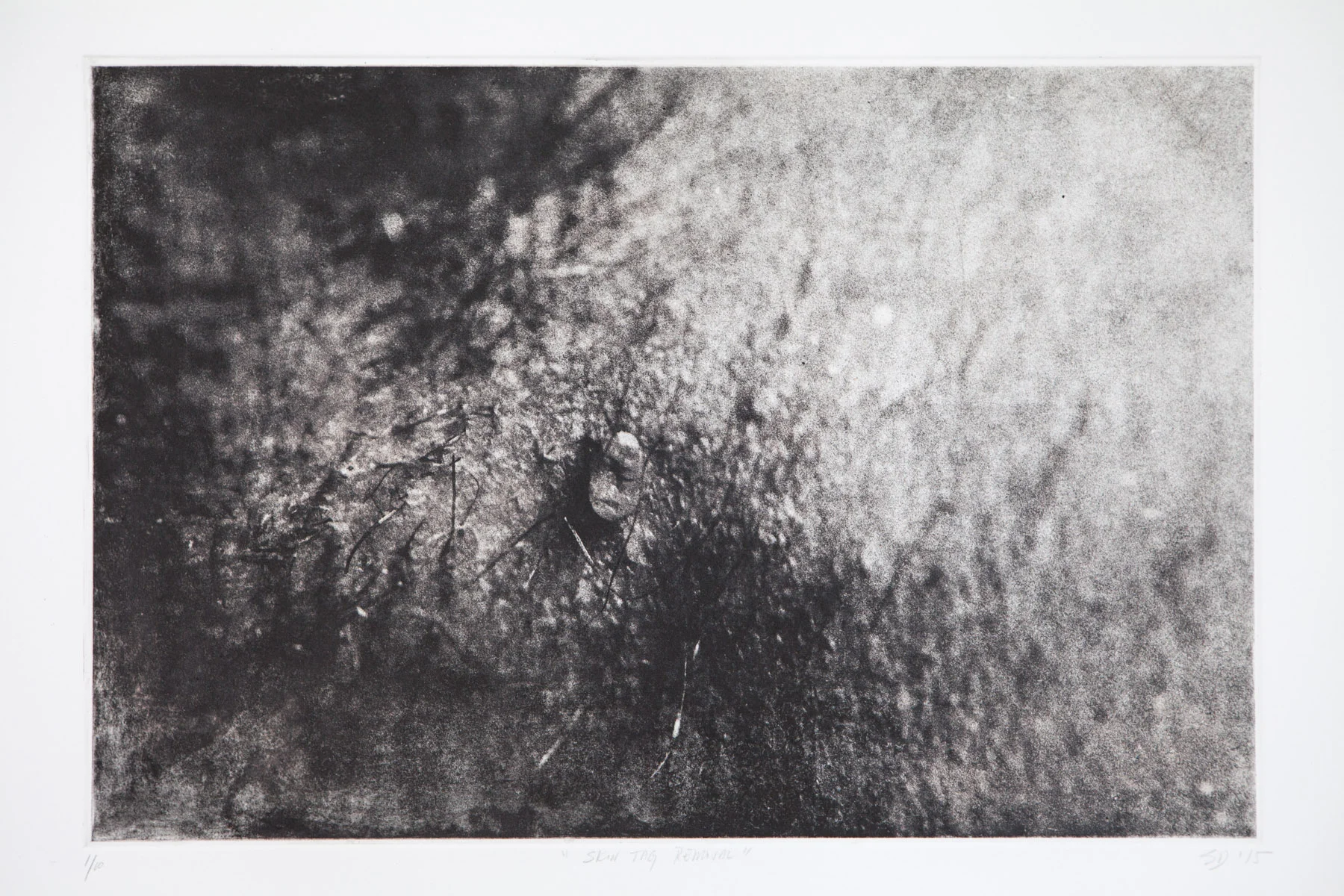 Skin Tag