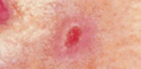 BASAL CELL CARCINOMA