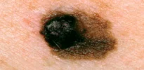 MELANOMA