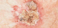 SQUAMOUS CELL CARCINOMA