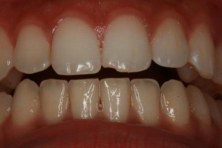 Before cosmetic bon ding to repair chipped tooth