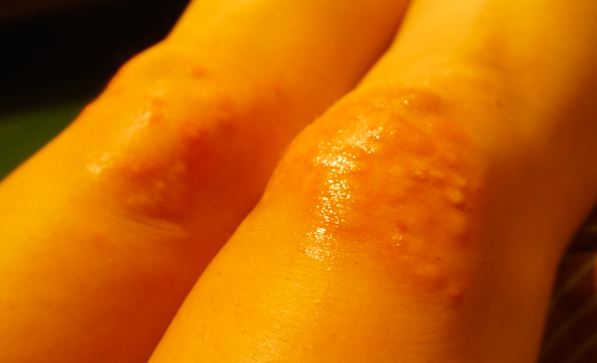 A CASE OF BEDBUGS