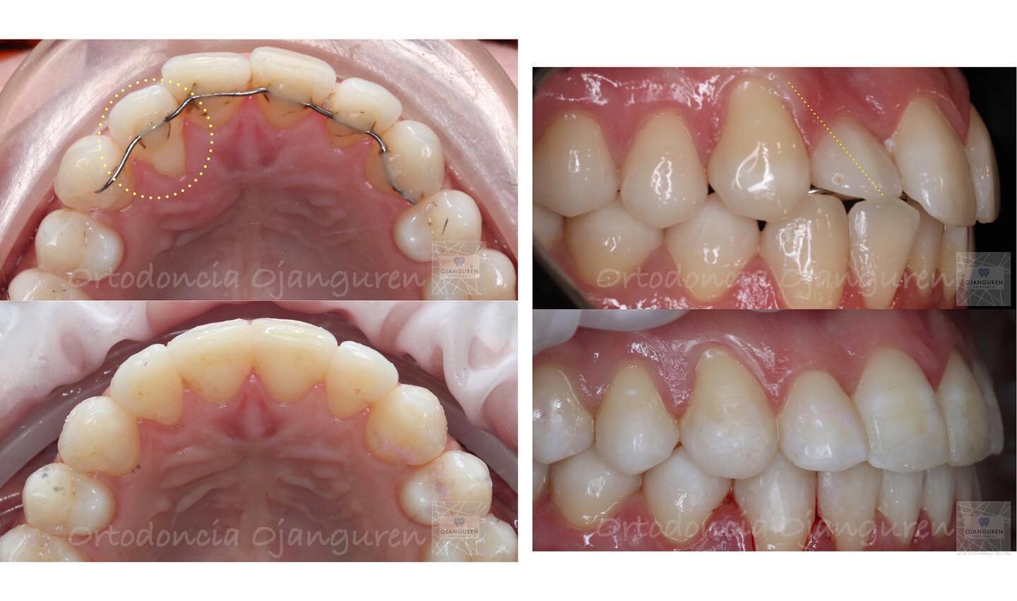 Las retenciones mal ajustadas pueden generarnos migraciones y otros problemas en los dientes 🤔
.
.
#ortodonciaojanguren #retencion #ortodoncialogro&ntilde;o #invisalign #orthodontics