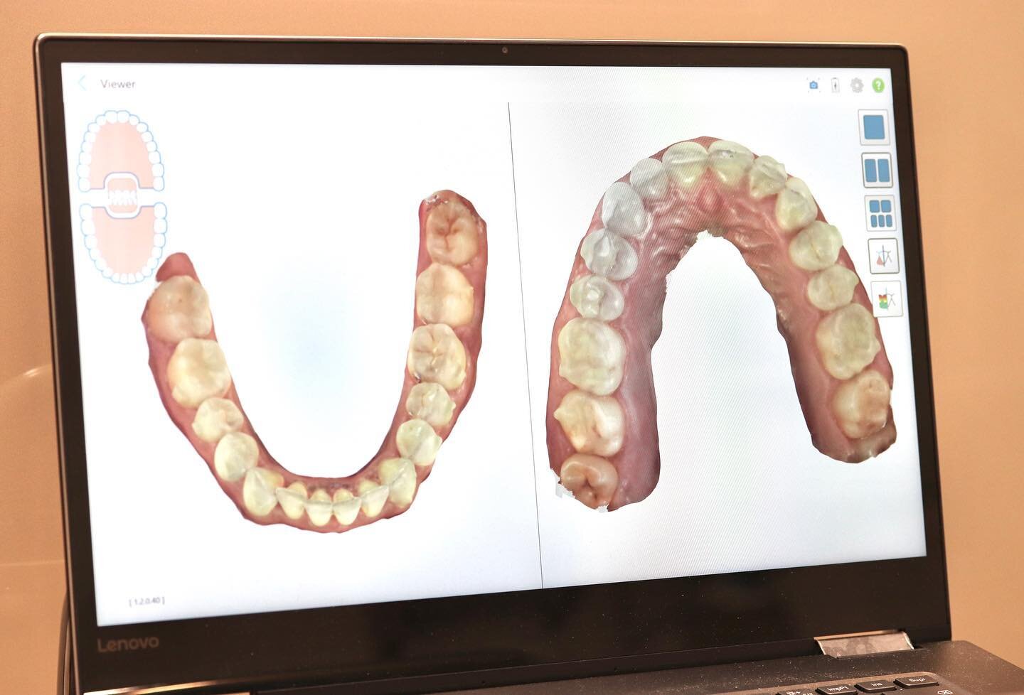 Registrar digitalmente la mordida tiene m&uacute;ltiples ventajas. Una de ellas es que podemos controlar los cambios que ocurren en los dientes/enc&iacute;a con el tiempo
.
.
#ortodonciadigital #itero #ortodonciainvisible #ortodonciaojanguren #digita