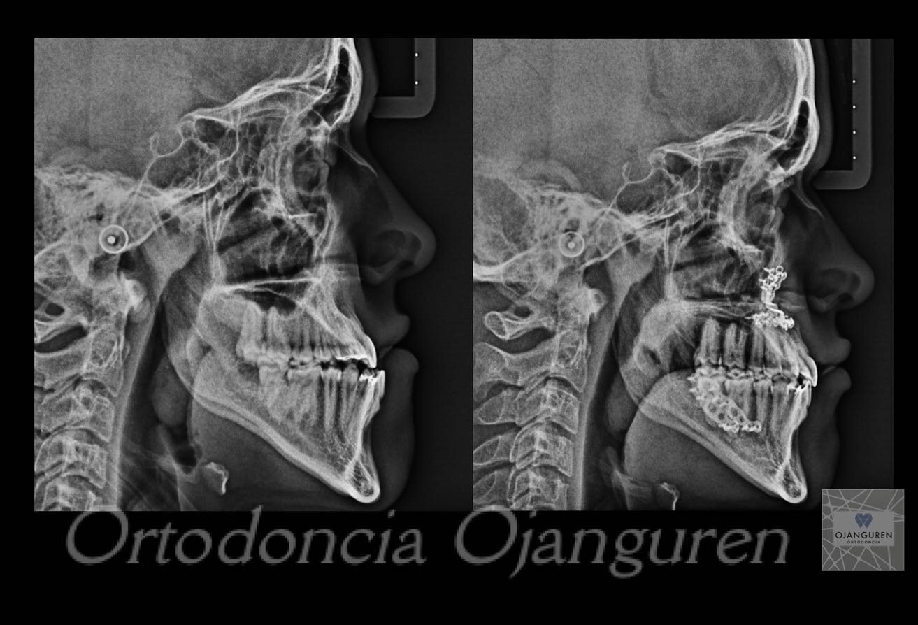 En ocasiones aunque hagamos tratamientos preventivos desde peque&ntilde;os tenemos que recurrir a la cirug&iacute;a ortogn&aacute;tica para corregir las maloclusiones 
.
.
#ortodonciaojanguren #ortodoncialogro&ntilde;o #orthognatic #cirugiaortognatic