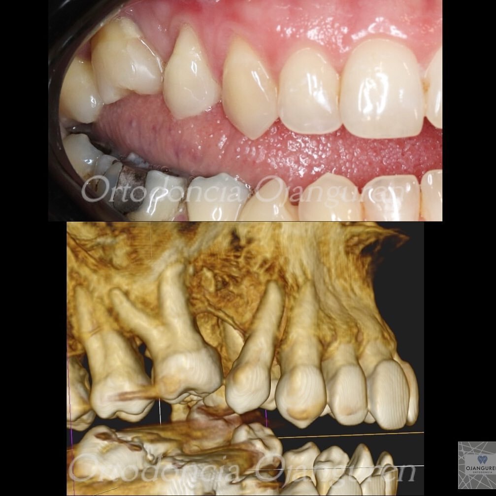La p&eacute;rdida dentaria puede ocasionar problemas de mordida y salud oral muy complejas
.
.
#ortodonciaojanguren #ortodoncialogro&ntilde;o #ausenciadentaria #mordidaabierta #maloclusion #orthognaticsurgery #orthodontics