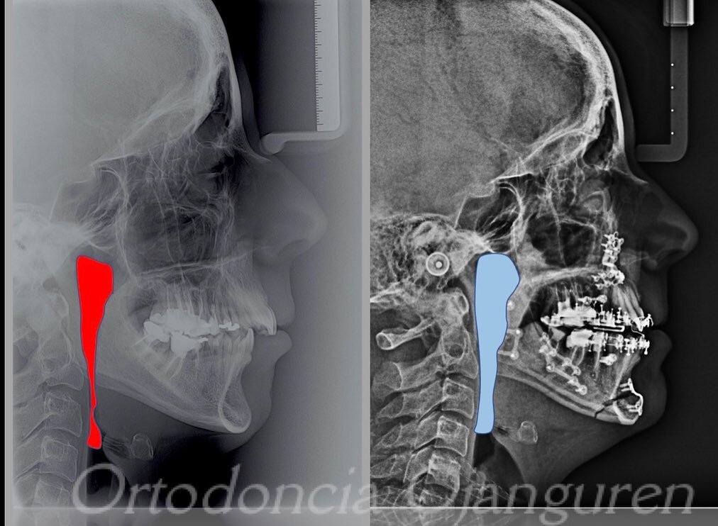 La Apnea del Sue&ntilde;o es unos de los problemas de salud p&uacute;blica m&aacute;s importantes en la actualidad. La Cirug&iacute;a Ortogn&aacute;tica permite resolver un 95% de los casos 👏🏻

.
.
#cirugiaortognatica #apnea #surgeryfirst #ortodonc