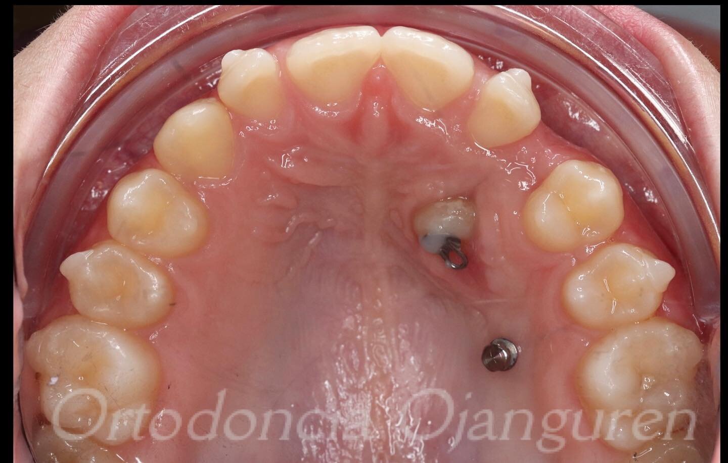 Tracci&oacute;n de caninos con alineadores
.
.
✨Microtornillo para tracci&oacute;n directa
✨Podemos tratar el resto de los dientes al mismo tiempo que movemos el canino
.
.
#invisalign  #invisalignteen #alineadores #ortodonciainvisible #ortodonciaoja