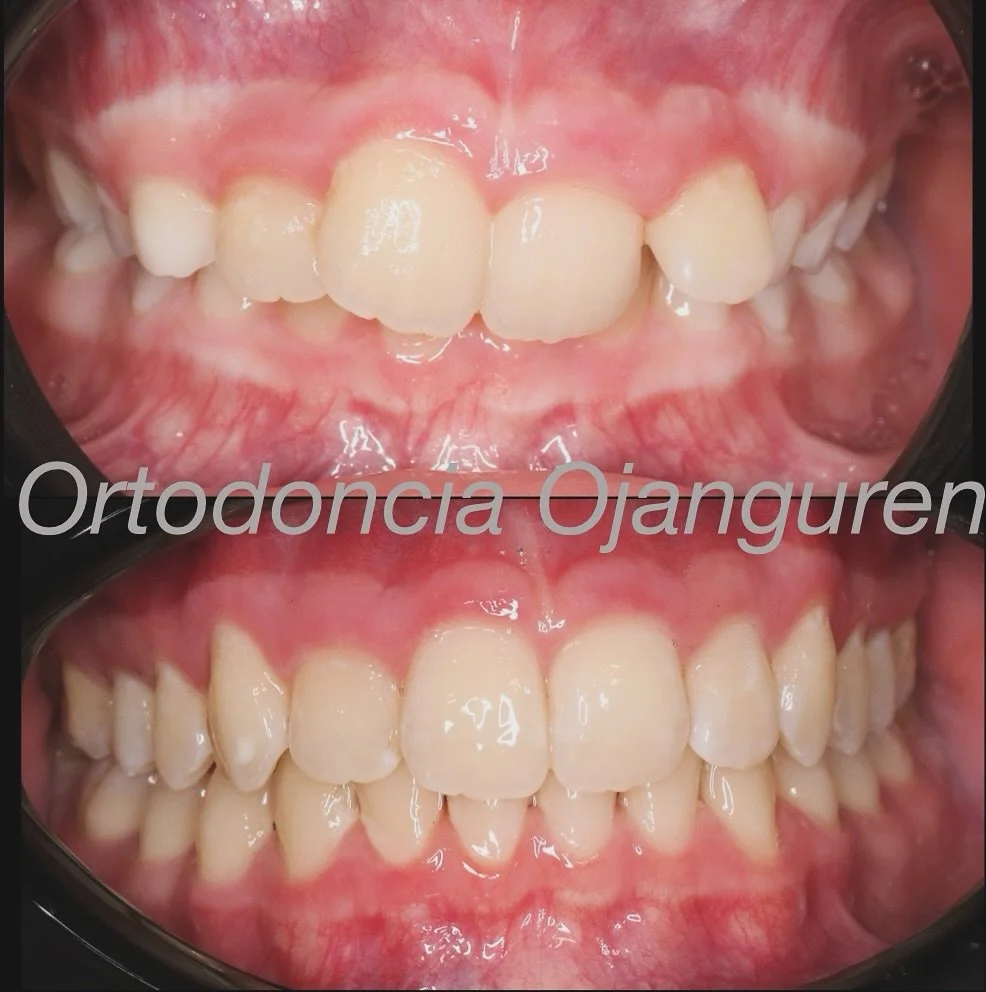 🤩 Ortopedia y Ortodoncia 🤩
Primera Fase: alineaci&oacute;n + avance mandibular
Segunda Fase: alineaci&oacute;n y nivelaci&oacute;n

En este caso todo el proceso con alineadores transparentes

.
📞 941 70 15 31
📍Parque del Carmen 6 Logro&ntilde;o

