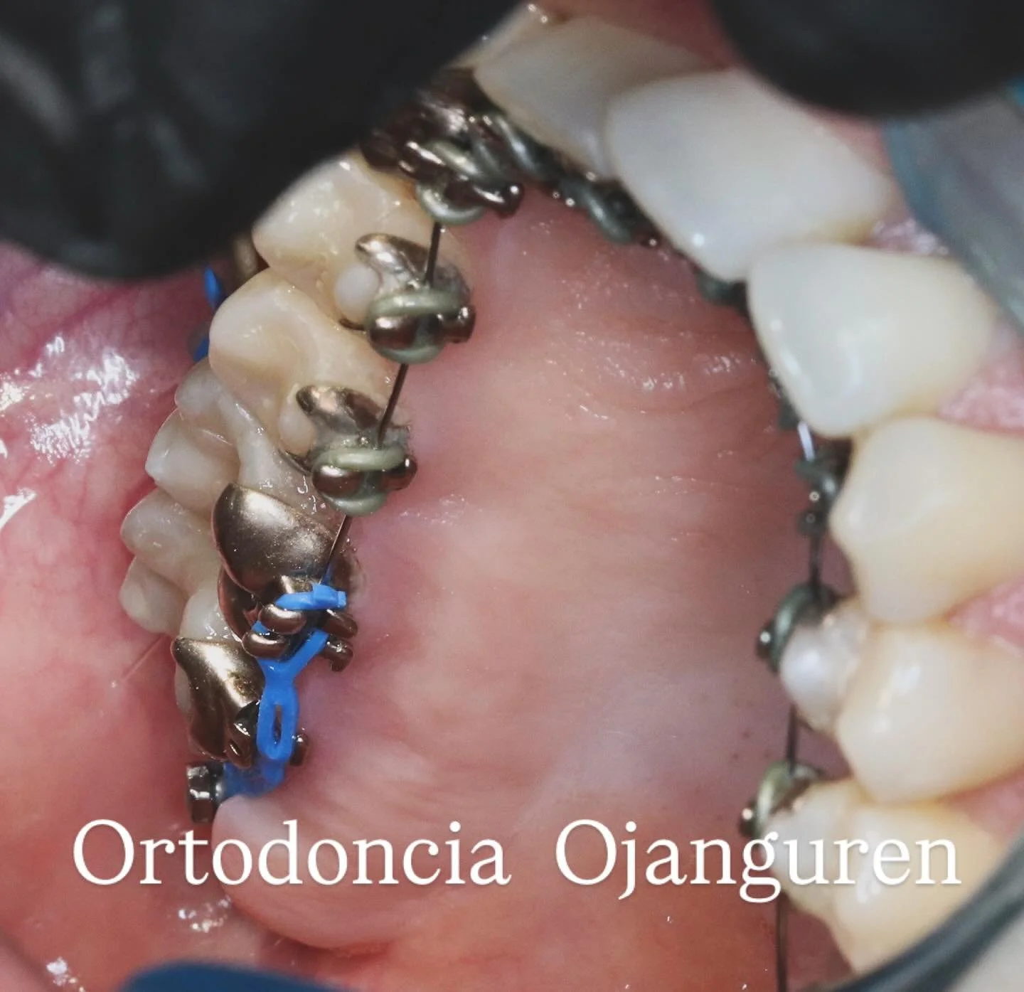 🦷La ortodoncia lingual se adapta a ti: m&aacute;xima precisi&oacute;n, est&eacute;tica e invisible 100%

⭐️ Est&eacute;tica total: los brackets quedan completamente ocultos detr&aacute;s de los dientes.
⭐️ Precisi&oacute;n y control: permite movimie