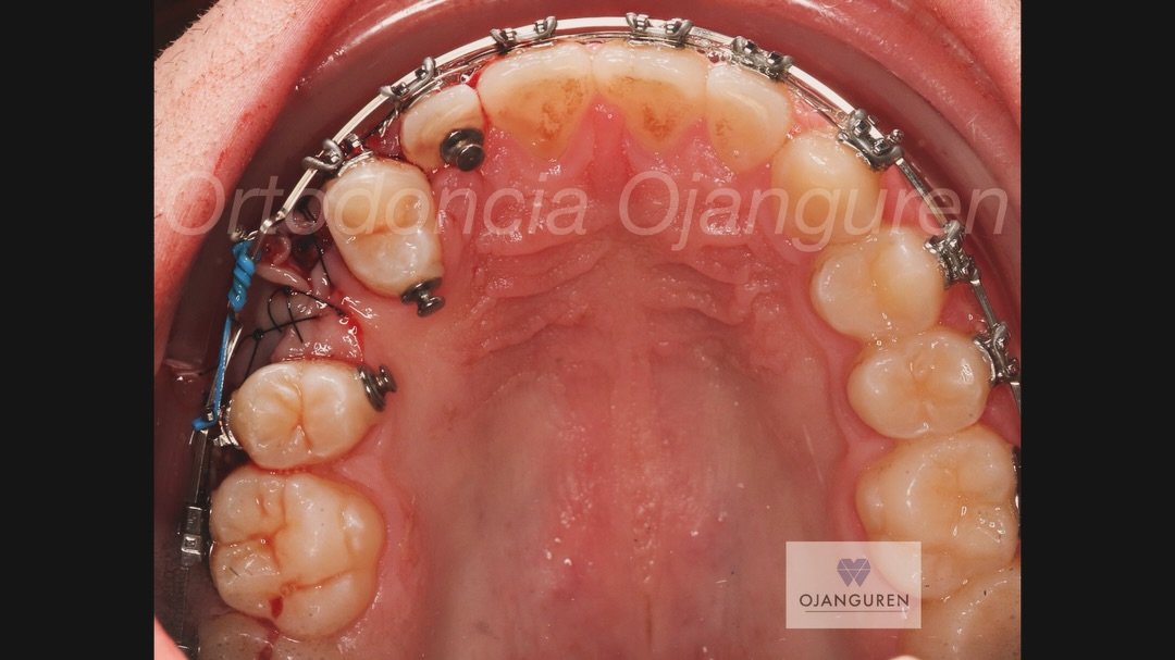 Continuamos con la transposici&oacute;n del canino con el premolar realizando la tracci&oacute;n 🔆

.
#ortodonciaojanguren #ortodoncialogro&ntilde;o #brackets #traccioncanino #caninoincluido #ortodoncia