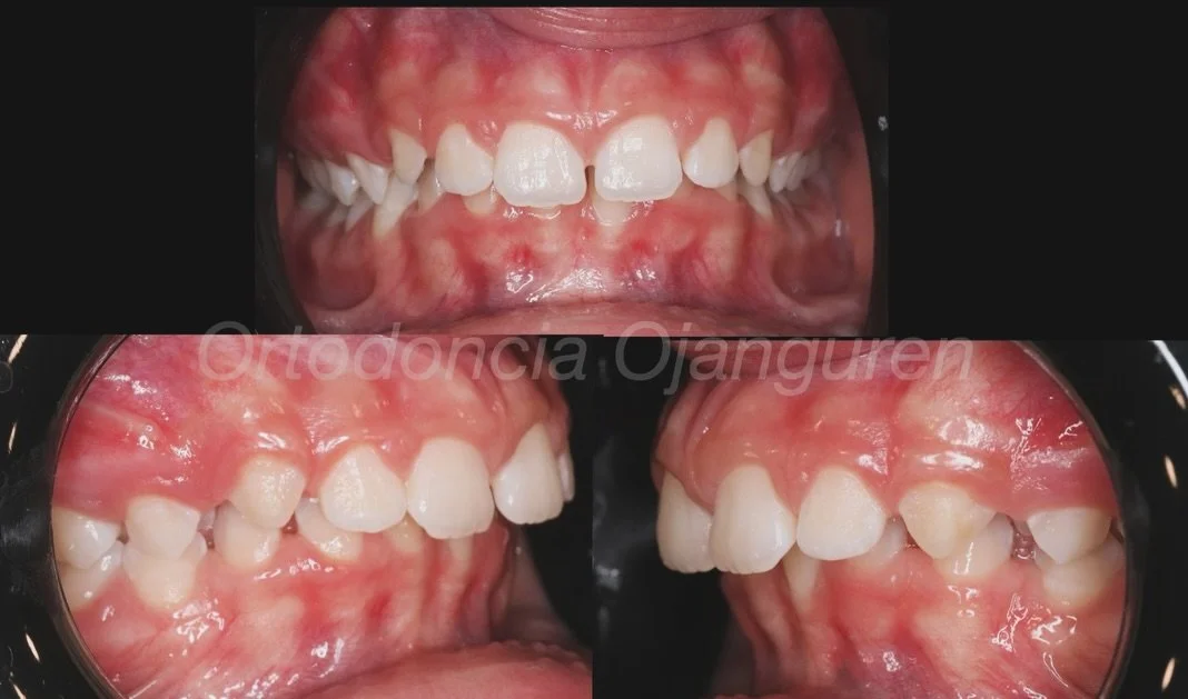 🔆Tratamiento de avance mandibular con alineadores🔆

Independientemente de la t&eacute;cnica utilizada:
🔹Pre-avance. Debemos preparar la oclusi&oacute;n previamente
🔹Avance Mandibular: Mediante bloques + el&aacute;sticos avanzaremos progresivament