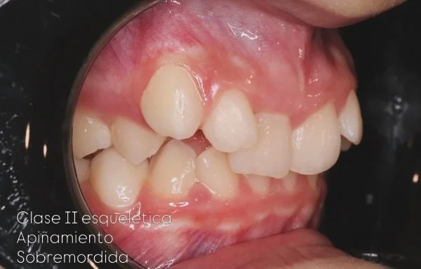 🔆Ortopedia + Ortodoncia🔆

Casos complejos donde debemos desbloquear la oclusi&oacute;n, ayudar al hueso a crecer de forma adecuada y darle un ambiente equilibrado

#ortodoncialogro&ntilde;o #ortodonciaojanguren #ojanguren