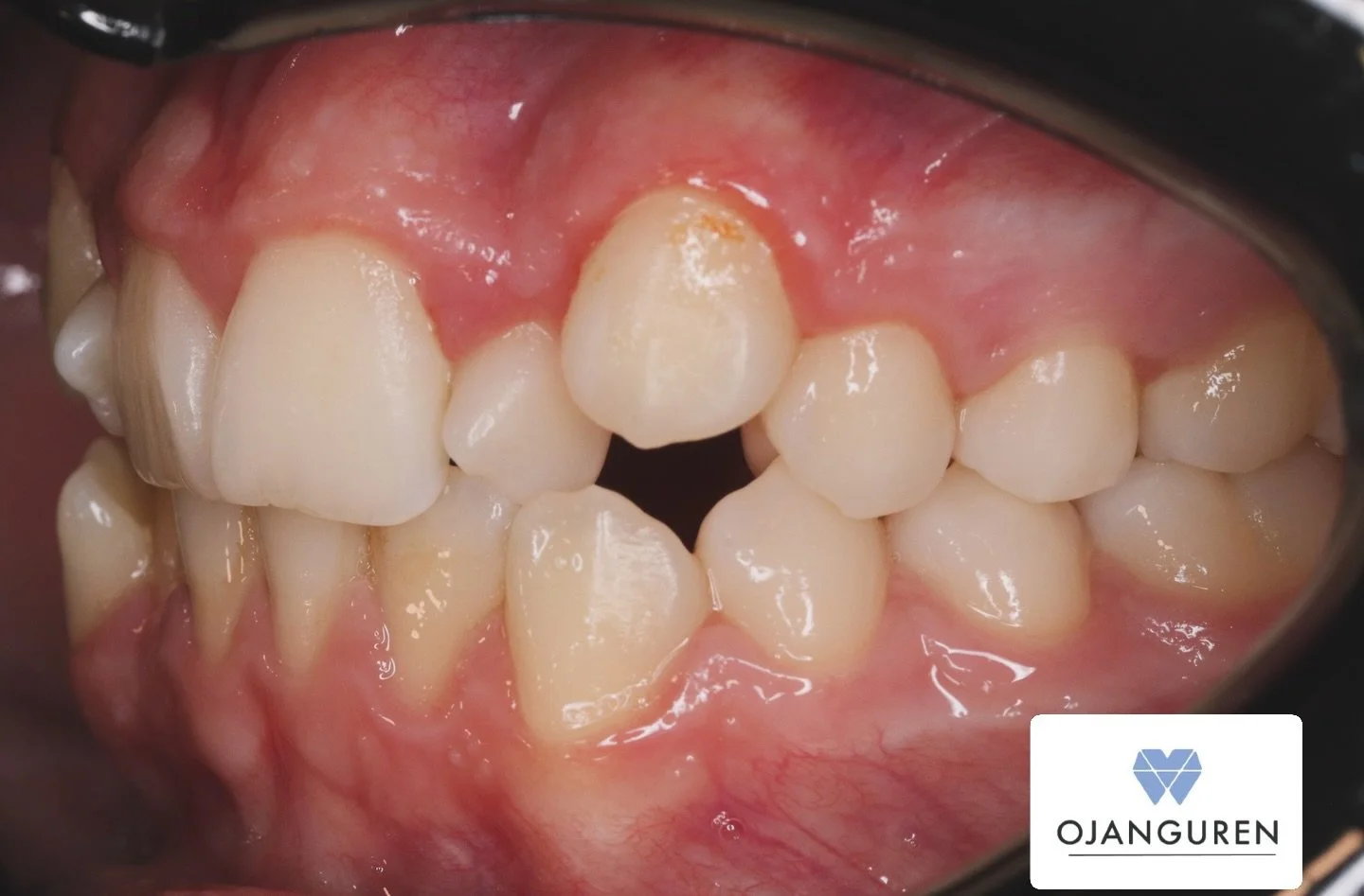 Antes 🔆 Despu&eacute;s

#ortodoncialogro&ntilde;o #ortodonciaojanguren #logro&ntilde;o