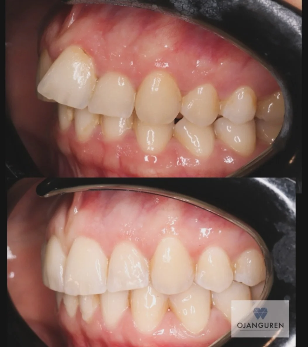 🩶 Clase II con resalte aumentado + api&ntilde;amiento 🩶