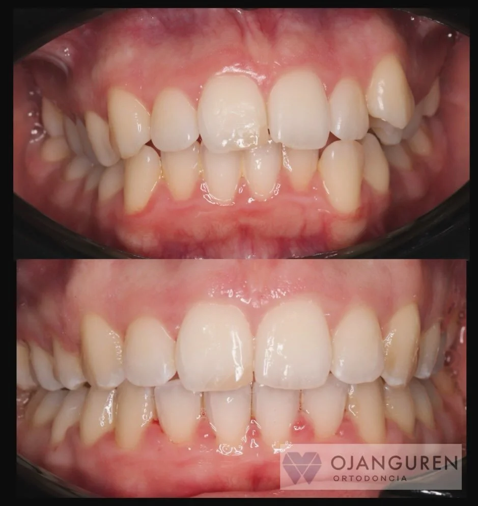 &iquest;Extracciones asim&eacute;tricas o no bilaterales?
Casos algo m&aacute;s complejos donde podemos plantearlo para corregir la oclusi&oacute;n adecuadamente sin necesidad de a&ntilde;adir mayor morbilidad 👌🏻

☎️941 70 15 31
Parque del Carmen 6