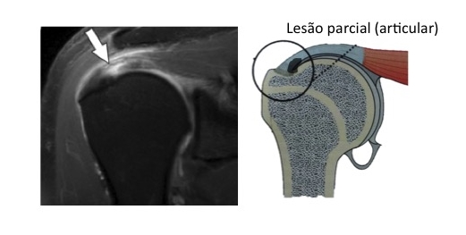 lesão parcial articular